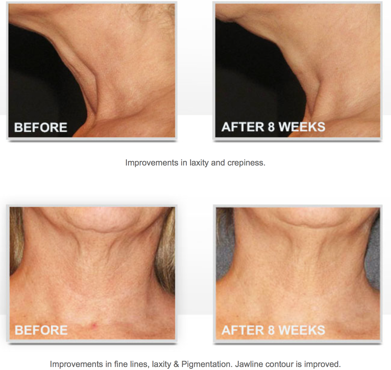 Triple Firming Neck